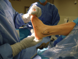 Ankle Replacement Pre-op