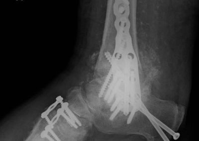 WHAT IS ANKLE ARTHRODESIS?