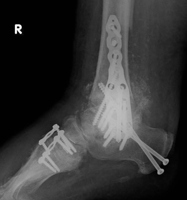 WHAT IS ANKLE ARTHRODESIS?