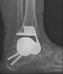 Talus with Tibia Replacement