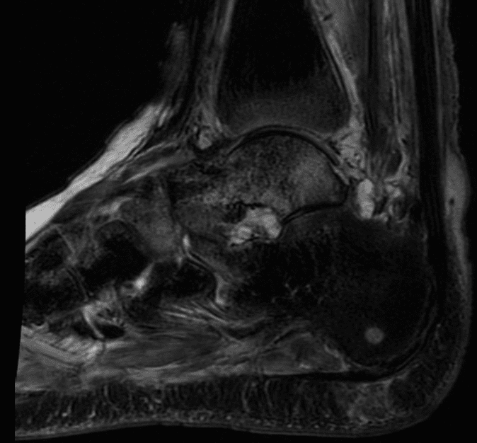 Avascular Necrosis MRI