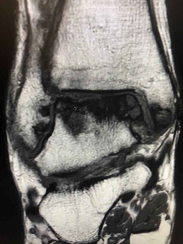Avascular Necrosis MRI